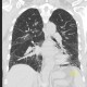 Chronic cardiac insufficiency, Kerley B lines: CT - Computed tomography